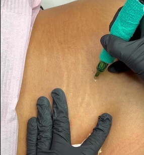 nanopigmentation vergeture saint nazaire la baule pornichet